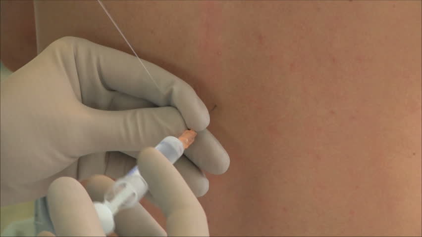 injection in the back with a closeup
