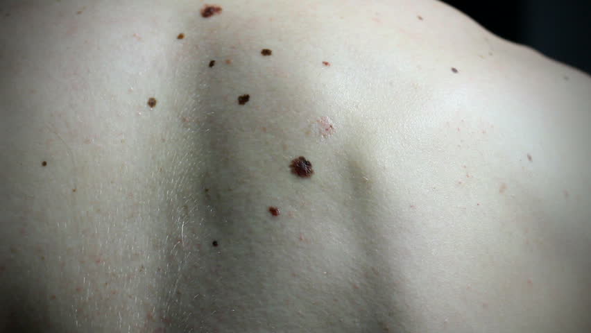 Human moles in close-up. HD1080p.