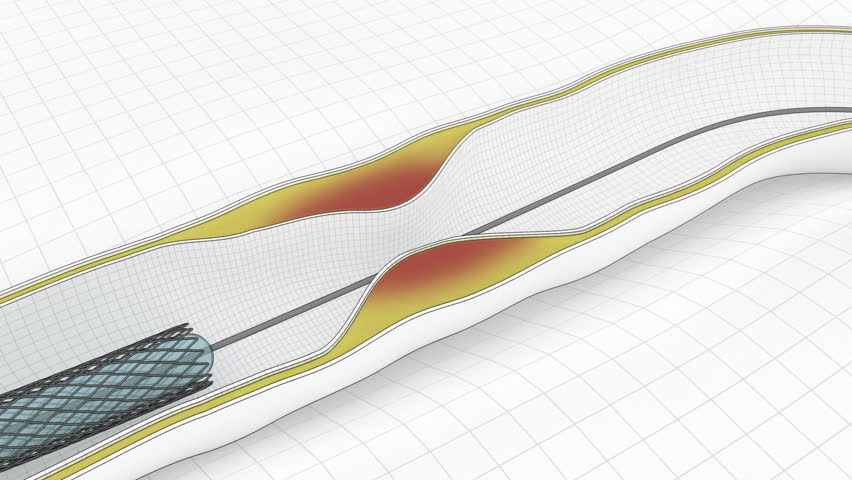 Coronary Angioplasty procedure with stent catheter - cartoon look
