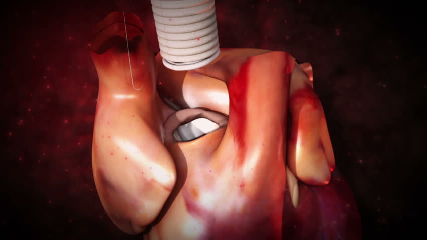 Aortic prosthesis surgery attachment of artificial prosthetic aortic valve to  heart in 3D CG animated human model