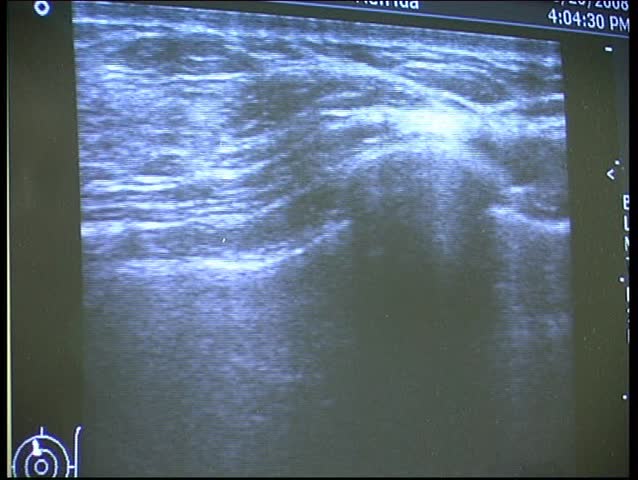 21 November, 2008. Kaliningrad. Russia. Observation of the patient in an urban hospital. The procedure for verifying the presence of breast cancer.