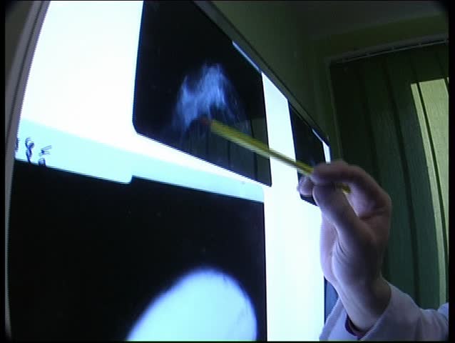 21 November, 2008. Kaliningrad. Russia. Observation of the patient in an urban hospital. The procedure for verifying the presence of breast cancer.