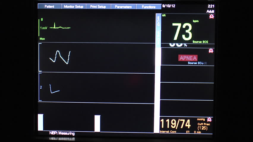 Apnea alarm flashes, signals respiratory distress on vital signs monitor displaying patient ECG, oxygen saturation, respiration and blood pressure. 1080p