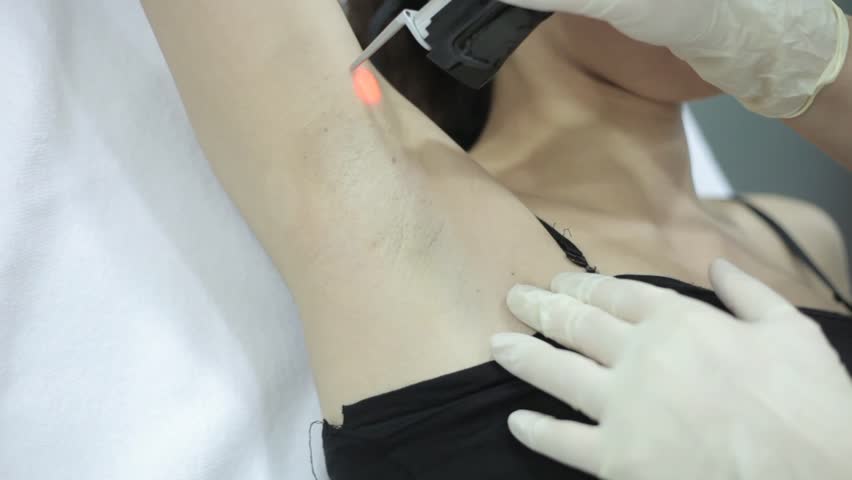 laser epilation