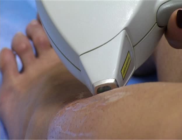 laser epilation