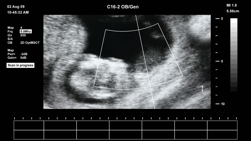 Medical ultrasound scan of human embryo		 
