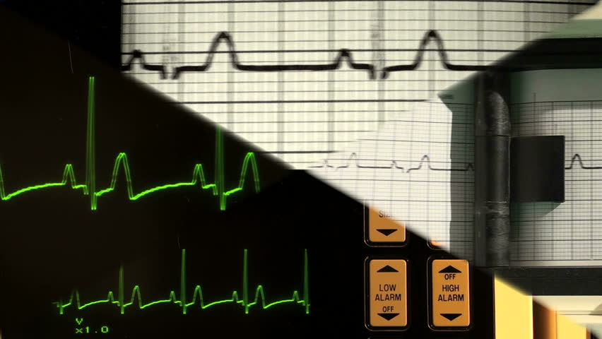 EKG montage - HD