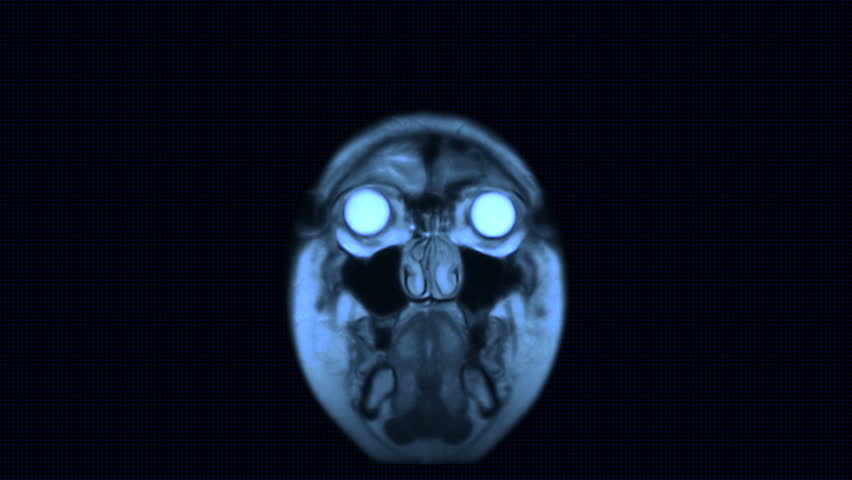 MRI brain scan