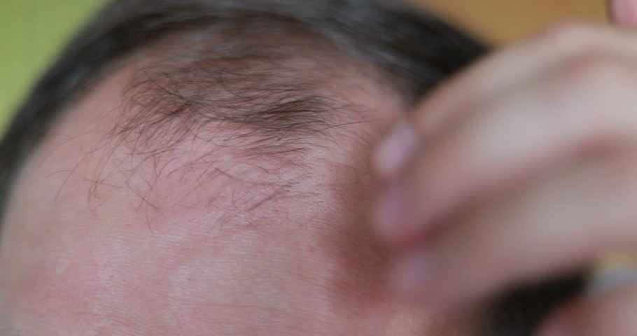 Bearded Man Standing In Front Of Mirror And Looking At His Thinning