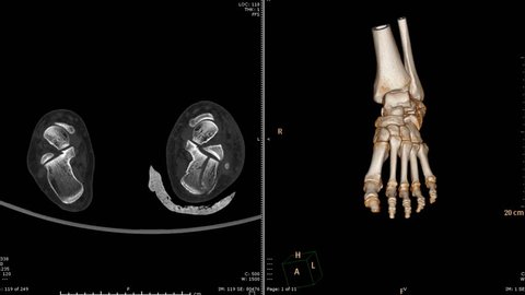 Ct Scan Left Foot Axial View Stock Footage Video 100 Royalty Free 1017921361 Shutterstock