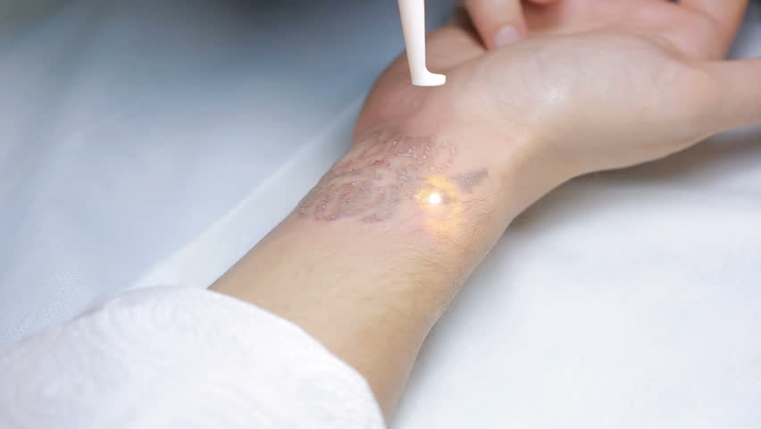 laser tattoo removal with hand stock footage video 22185067 laser tattoo removal with hand stock footage video 22185067