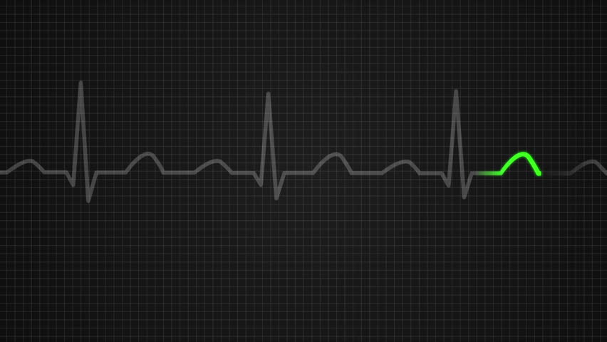 Animation Of Schematic Diagram Of Normal Sinus Rhythm For A Human Heart ...
